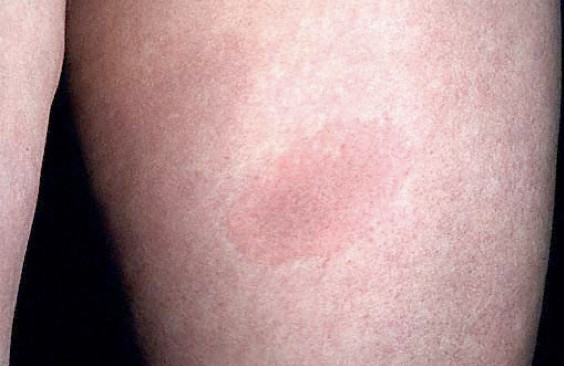 Erythema Migrans Rash Origins Of Health Llc